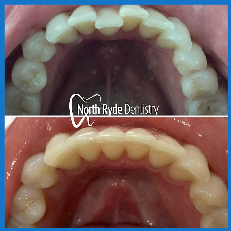 Invisible braces in North Ryde
