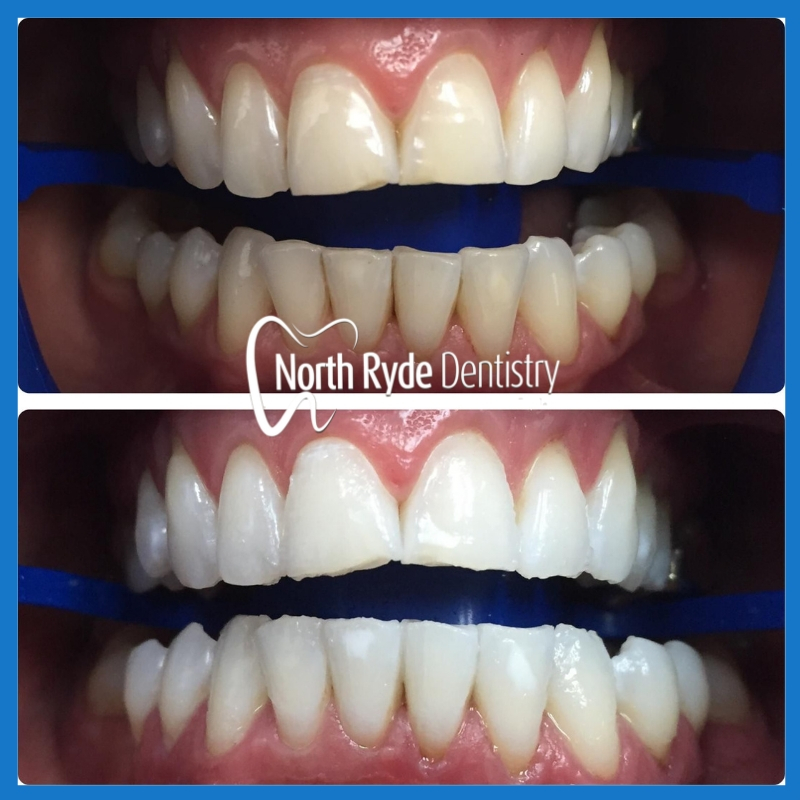 Teeth Whitening in North Ryde