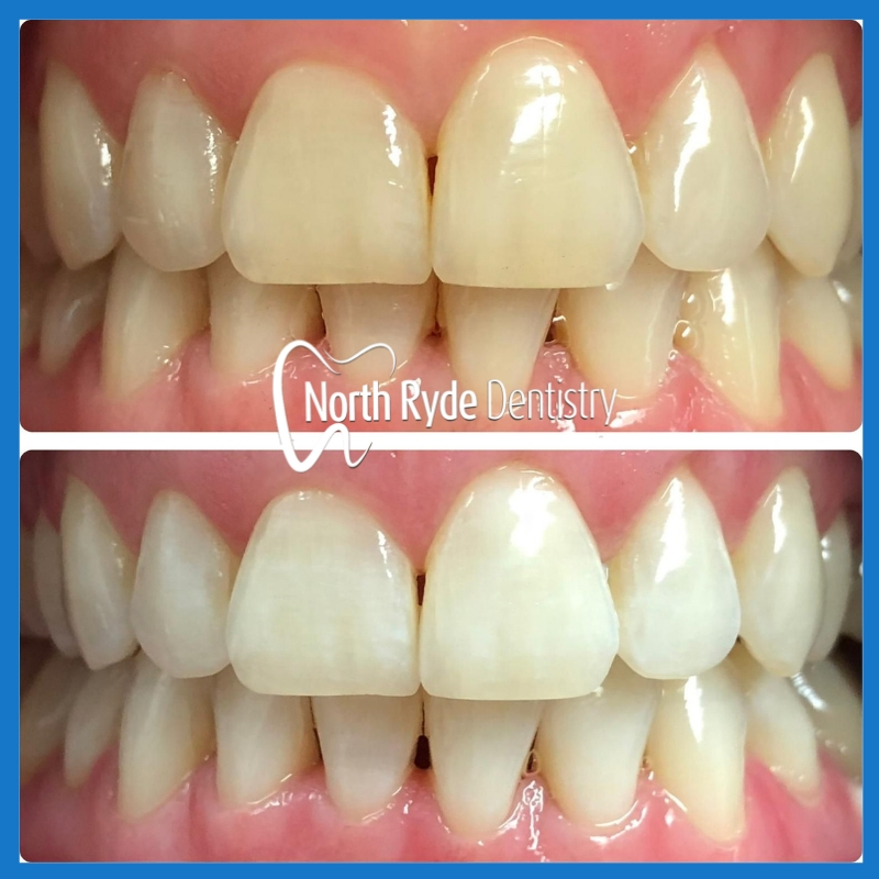 Affordable teeth whitening in Macquarie Park