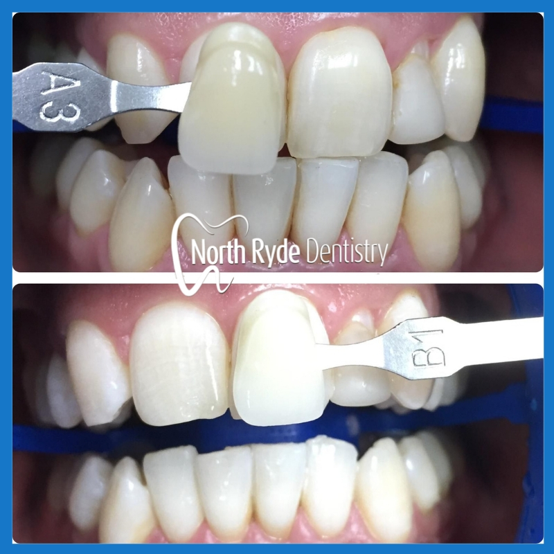 Affordable teeth whitening in North Ryde