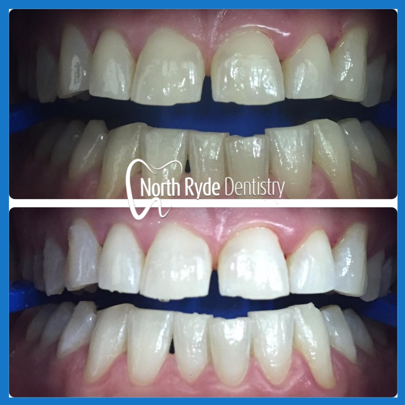 Best teeth whitening in North Ryde