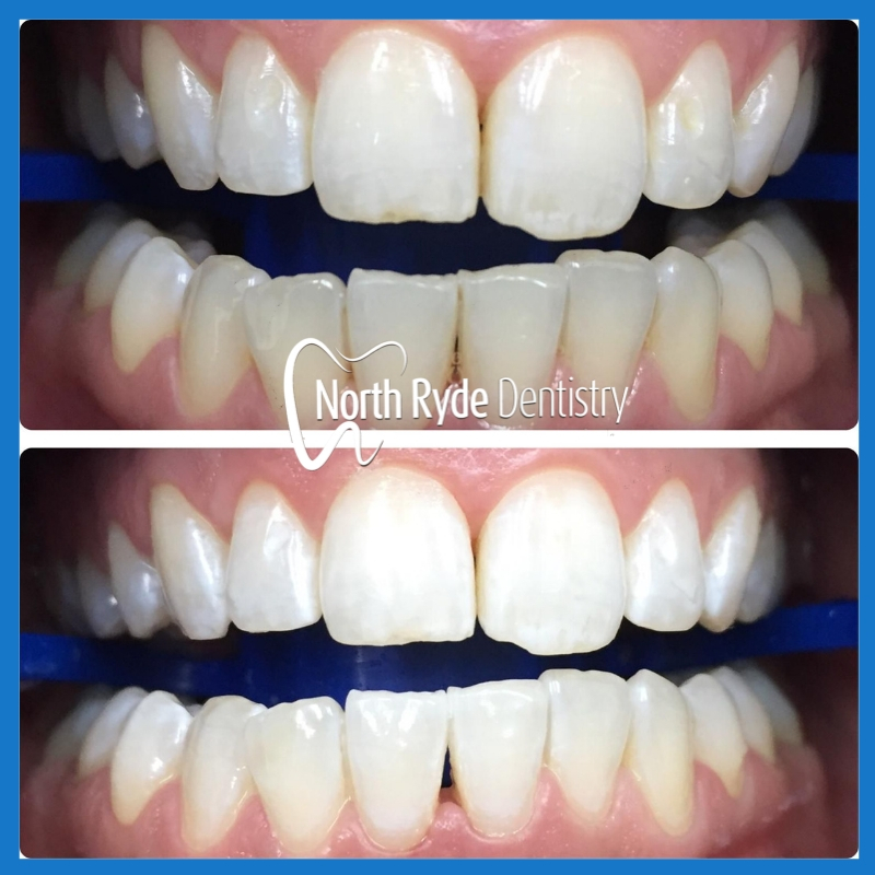 Best dentist for teeth whitening in North Ryde.