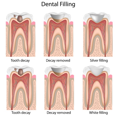 Dental Fillings and Restorations in Macquarie Park