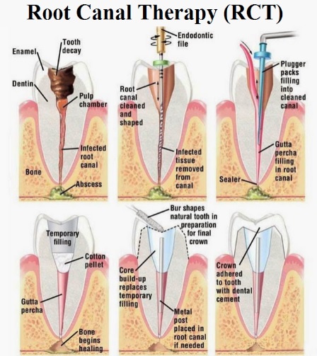 We offer root canal therapy here in Macquarie Park