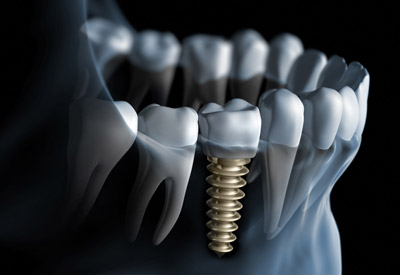 What Are Dental Implants?