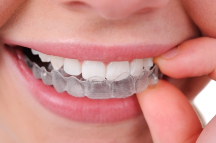 We are the best Invisalign provider in North Ryde.