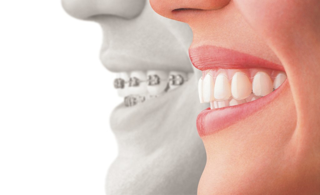 We are the experts when it comes to Invisalign here in North Ryde.