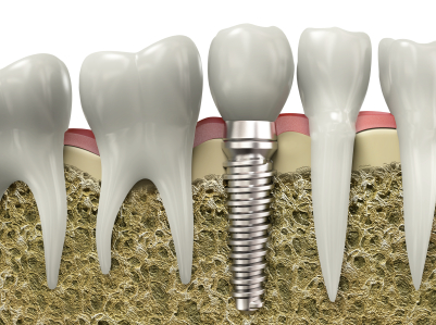 We have the best dental implants in North Ryde.