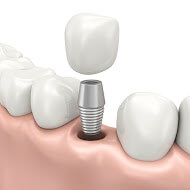 We provide high quality dental implant here in Macquarie Park