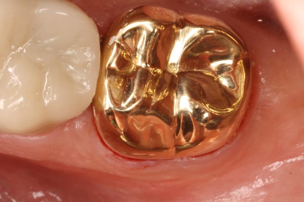 Gold/Metal Crown is also available here in North Ryde Dentistry at Macquarie Park