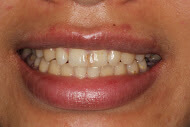 Before having dental veneers from Macquarie Park