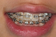 Before veneers treatment in Macquarie Park