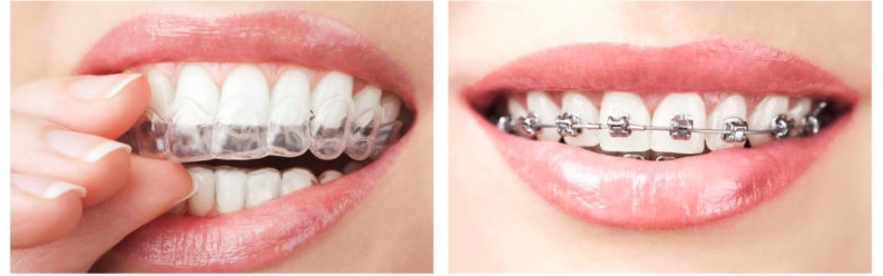 We have Invisalign and Braces special offer here in Macquarie Park