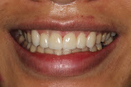 Porcelain Veneers done here at Macquarie Park