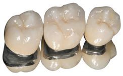 Porcelain Fused to Metal Crown is available here in Macquarie Park