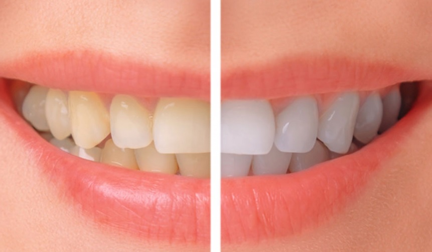 Teeth Whitening Specials here in Macquarie Park