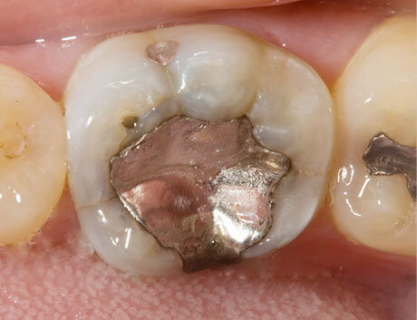 We provide Zirconia crowns here in Macquarie Park