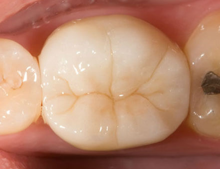 Zirconia crown available here in Macquarie Park