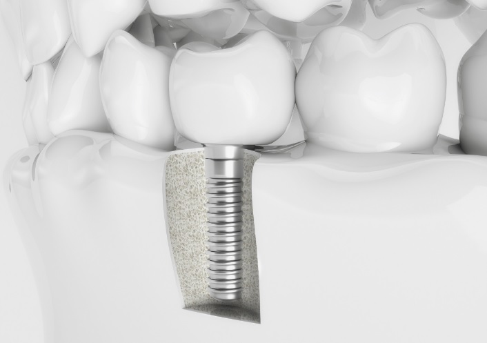 Dental implant cost in North Ryde