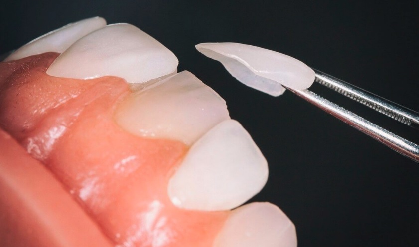 Dental veneers in North Ryde