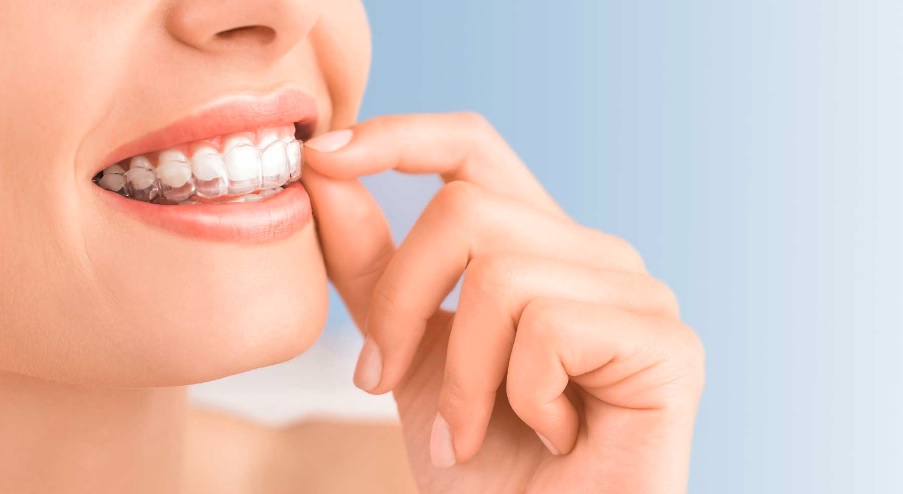 Invisalign in North Ryde