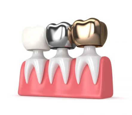 Dental crowns in Macquarie Park