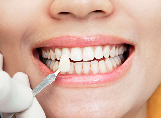 The best dental veneers in Macquarie Park.