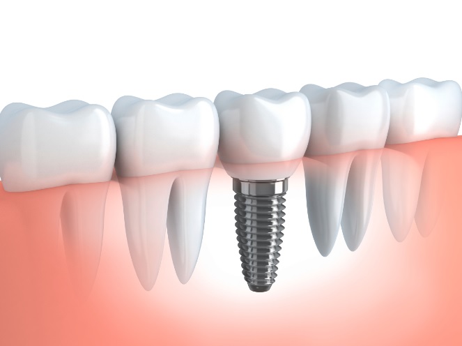We have the best dental implants in Macquarie Park.