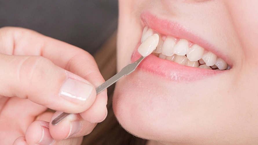 Dental veneers in Macquarie Park