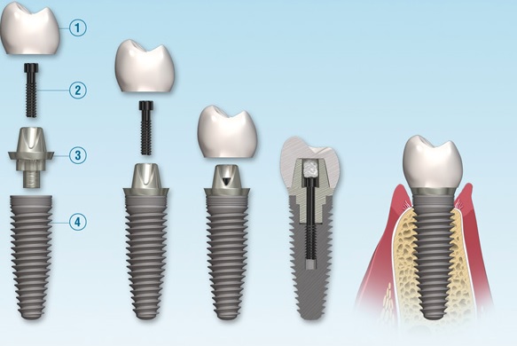 Dental implant cost in North Ryde
