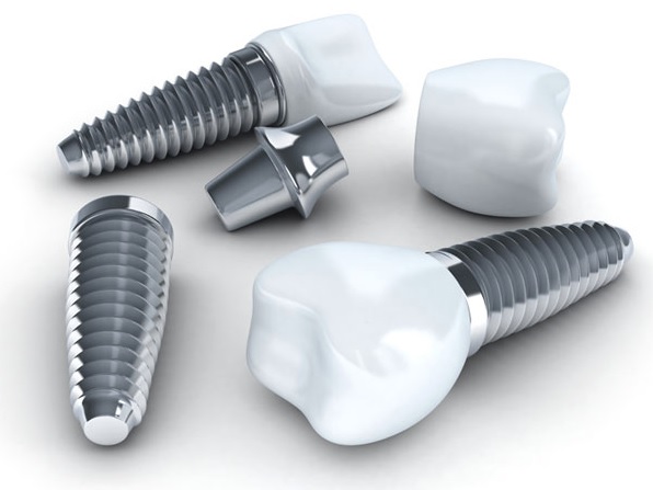Are Dental Implants Worth It? Things to Consider