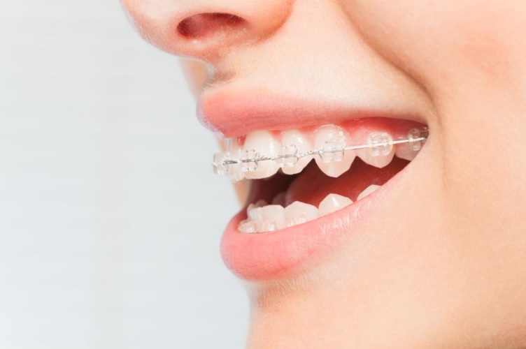 Orthodontics in Macquarie park