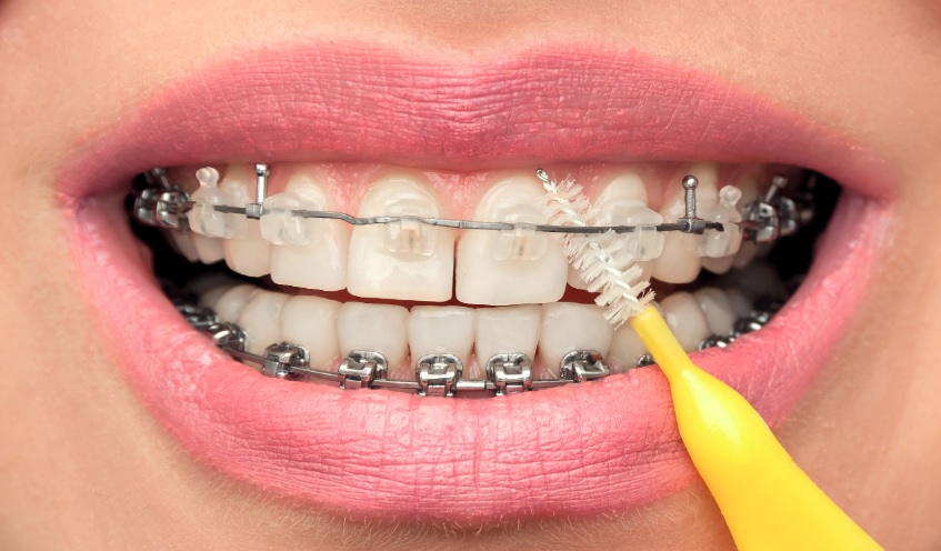 We have the best orthodontist in Macquarie Park.