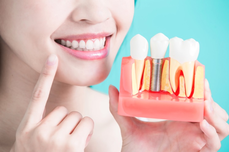 We have the best dental implants in Macquarie Park.