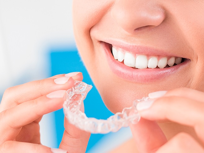 Invisalign cost in Macquarie park