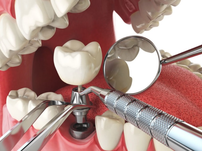 We have the best dentist for dental implants here in North Ryde.