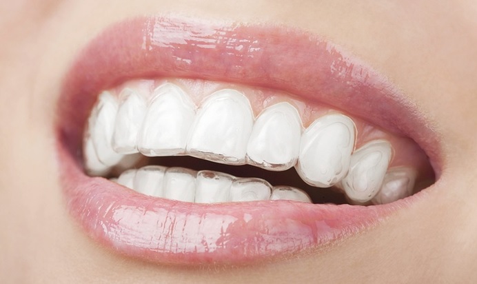 Invisalign cost in Macquarie park