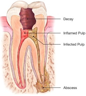 root canal therapy in Macquarie Park