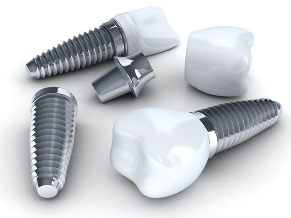 We have the best dentist for dental implants here in North Ryde.