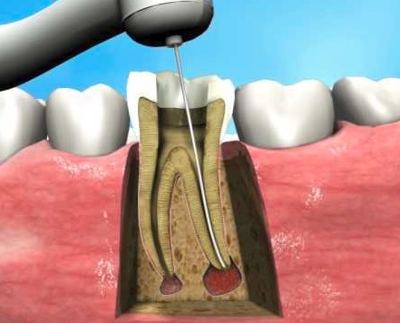 root canal cost in North Ryde