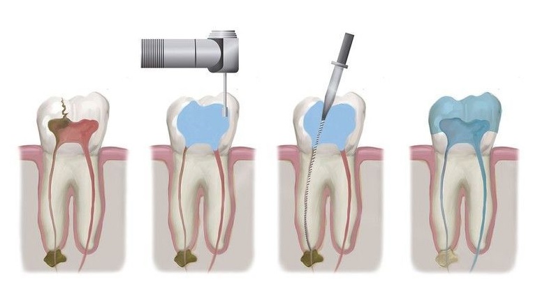 root canal therapy in Macquarie Park