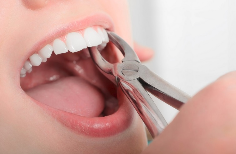 wisdom teeth removal in North Ryde