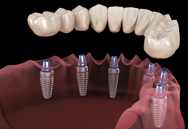 Full Dental Implants in Macquarie Park