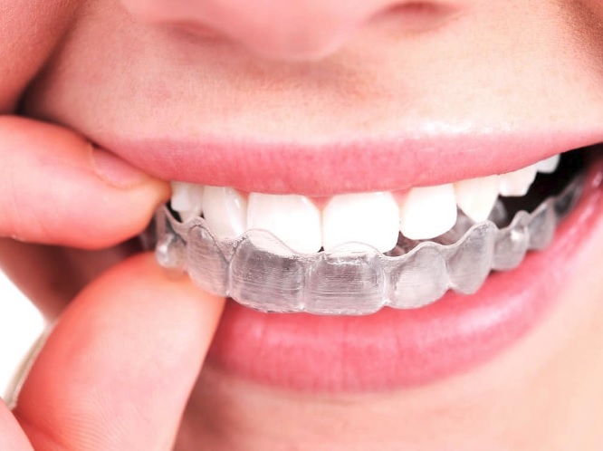 Invisalign in North Ryde