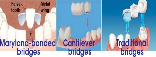 Dental bridge in Macquarie park