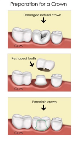 dental crown procedure in North Ryde