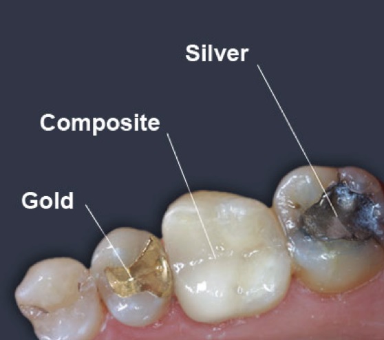 Dental Filling Materials in Macquarie Park: Your Options