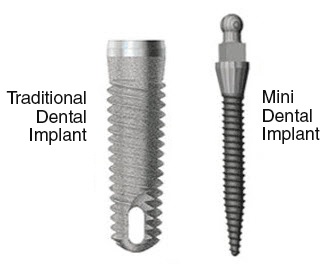 Mini dental implants in Macquarie park
