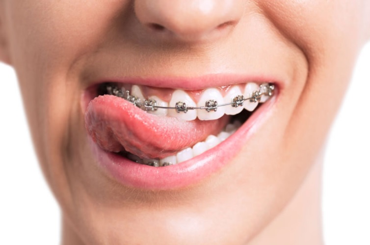 Orthodontic treatment in Macquarie park