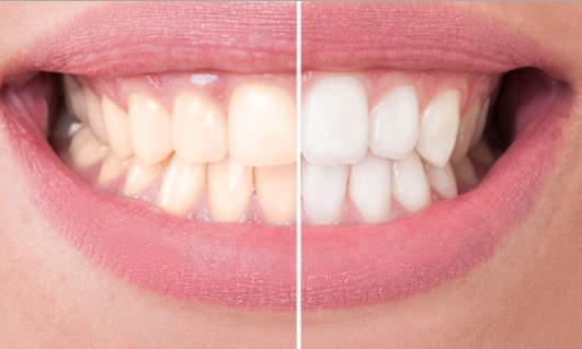 Best teeth whitening in Macquarie Park